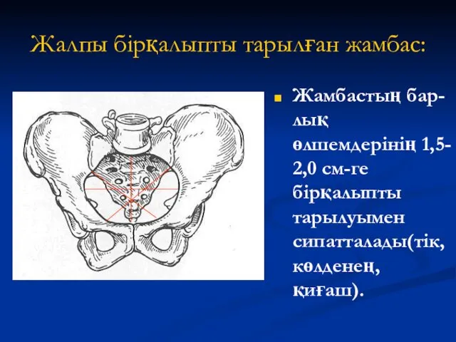 Жалпы бірқалыпты тарылған жамбас: Жамбастың бар-лық өлшемдерінің 1,5- 2,0 см-ге бірқалыпты тарылуымен сипатталады(тік,көлденең,қиғаш).