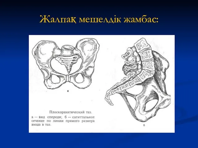 Жалпақ мешелдік жамбас: