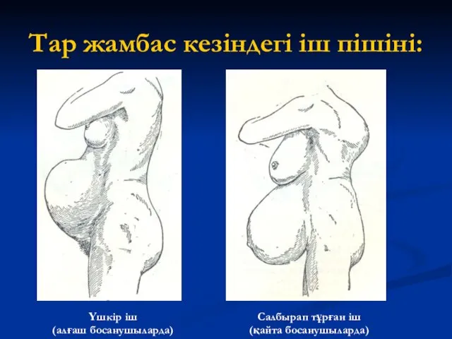 Тар жамбас кезіндегі іш пішіні: Үшкір іш (алғаш босанушыларда) Салбырап тұрған іш (қайта босанушыларда)