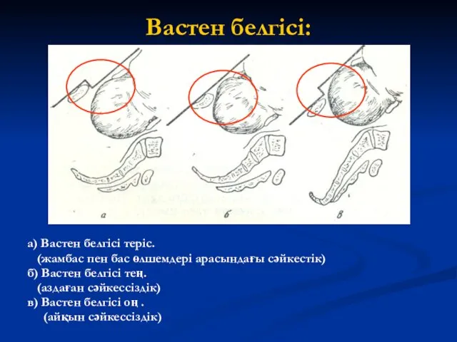 Вастен белгісі: а) Вастен белгісі теріс. (жамбас пен бас өлшемдері