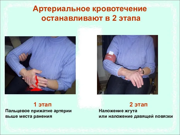 Артериальное кровотечение останавливают в 2 этапа 1 этап Пальцевое прижатие