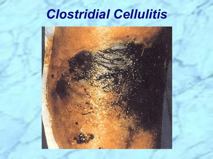 Clostridial Cellulitis