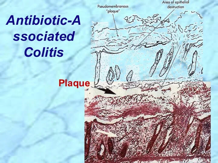Antibiotic-Associated Colitis Plaque