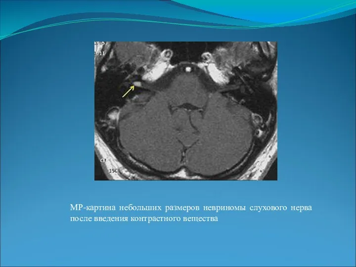 МР-картина небольших размеров невриномы слухового нерва после введения контрастного вещества
