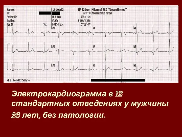 Электрокардиограмма в 12 стандартных отведениях у мужчины 26 лет, без патологии.