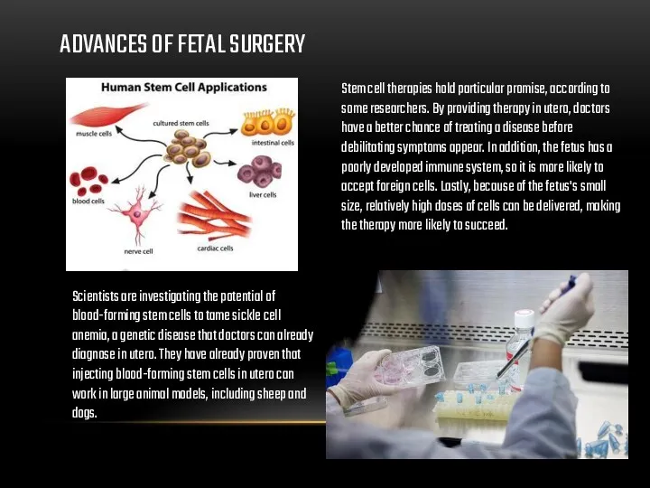 ADVANCES OF FETAL SURGERY Stem cell therapies hold particular promise,