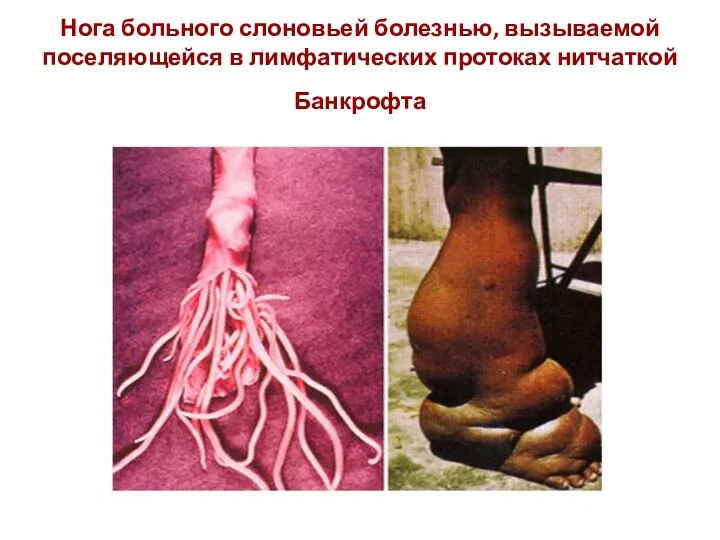 Нога больного слоновьей болезнью, вызываемой поселяющейся в лимфатических протоках нитчаткой Банкрофта