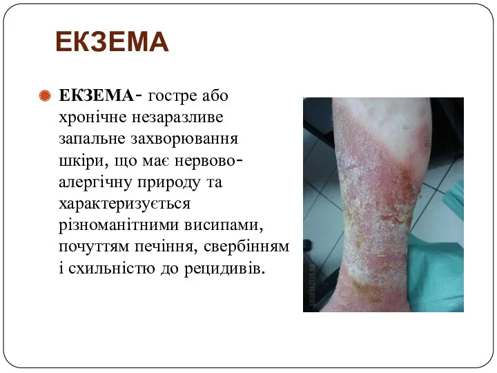 ЕКЗЕМА ЕКЗЕМА- гостре або хронічне незаразливе запальне захворювання шкіри, що має нервово-алергічну природу