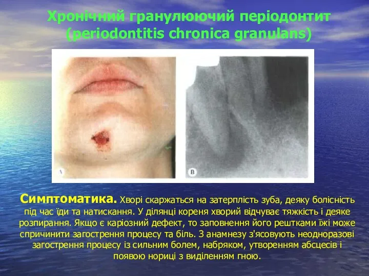 Хронічний гранулюючий періодонтит (periodontitis chronica granulans) Симптоматика. Хворі скаржаться на