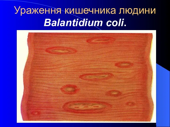 Ураження кишечника людини Balantidium coli.