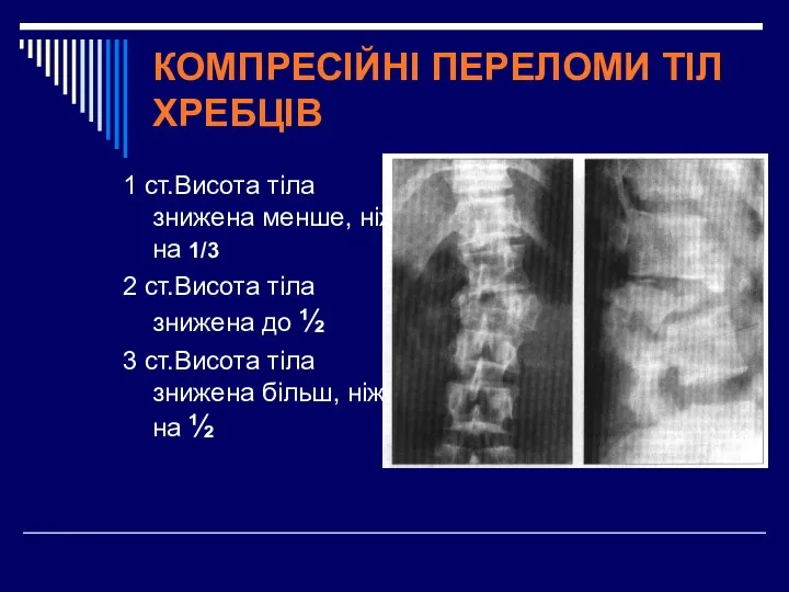 КОМПРЕСІЙНІ ПЕРЕЛОМИ ТІЛ ХРЕБЦІВ 1 ст.Висота тіла знижена менше, ніж