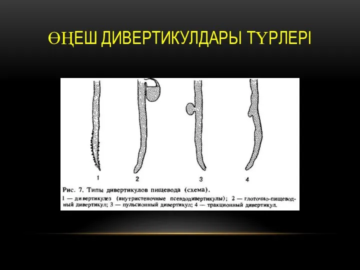 ӨҢЕШ ДИВЕРТИКУЛДАРЫ ТҮРЛЕРІ