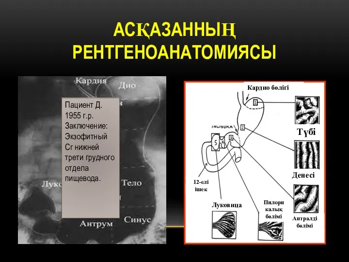 АСҚАЗАННЫҢ РЕНТГЕНОАНАТОМИЯСЫ Пациент Д. 1955 г.р. Заключение: Экзофитный Cr нижней трети грудного отдела пищевода.