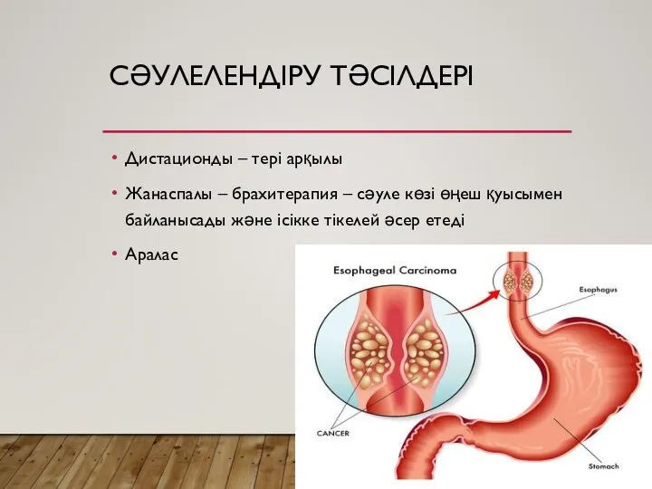 СӘУЛЕЛЕНДІРУ ТӘСІЛДЕРІ Дистационды – тері арқылы Жанаспалы – брахитерапия – сәуле көзі өңеш