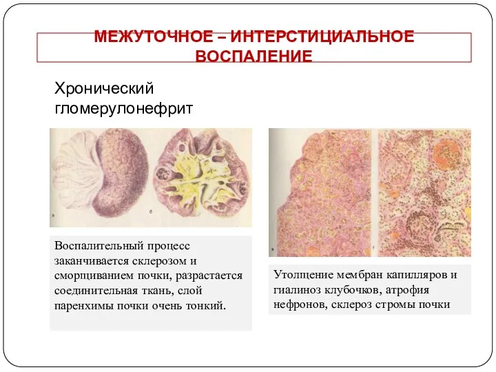 МЕЖУТОЧНОЕ – ИНТЕРСТИЦИАЛЬНОЕ ВОСПАЛЕНИЕ Хронический гломерулонефрит Воспалительный процесс заканчивается склерозом