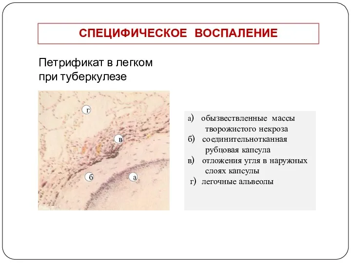 Петрификат в легком при туберкулезе а) обызвествленные массы творожистого некроза