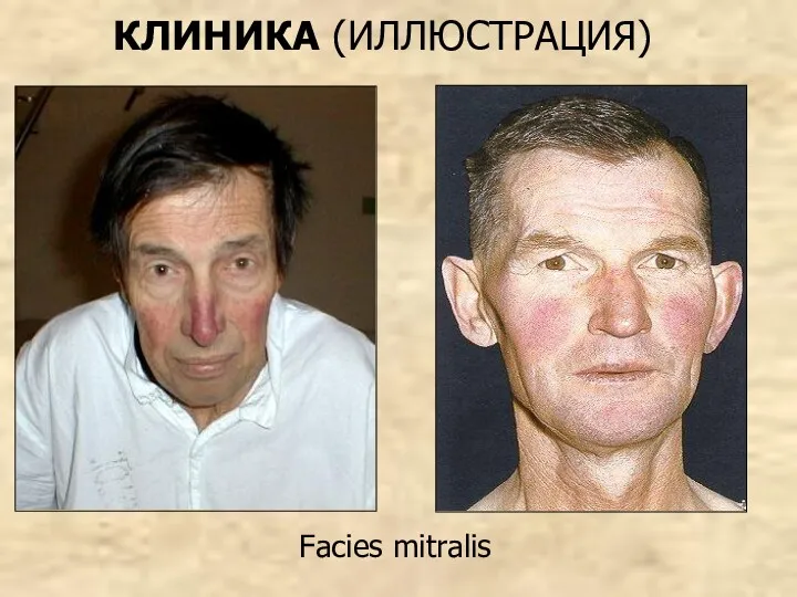 Facies mitralis КЛИНИКА (ИЛЛЮСТРАЦИЯ)