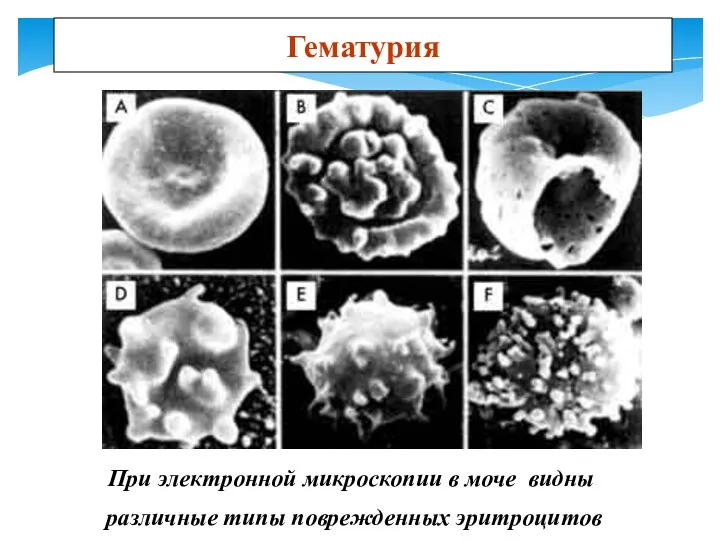 При электронной микроскопии в моче видны различные типы поврежденных эритроцитов Гематурия