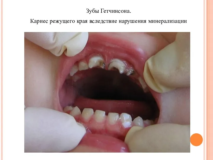 Зубы Гетчинсона. Кариес режущего края вследствие нарушения минерализации