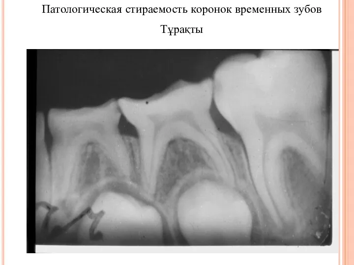 Патологическая стираемость коронок временных зубов Тұрақты