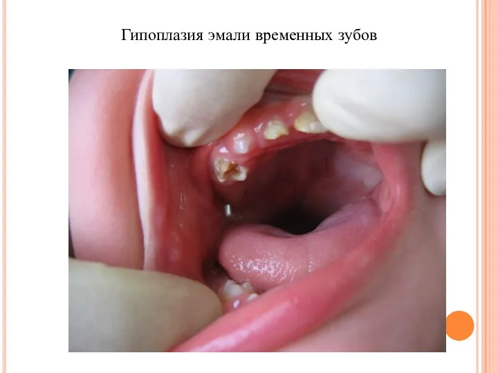 Гипоплазия эмали временных зубов