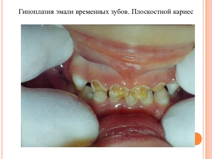 Гипоплазия эмали временных зубов. Плоскостной кариес