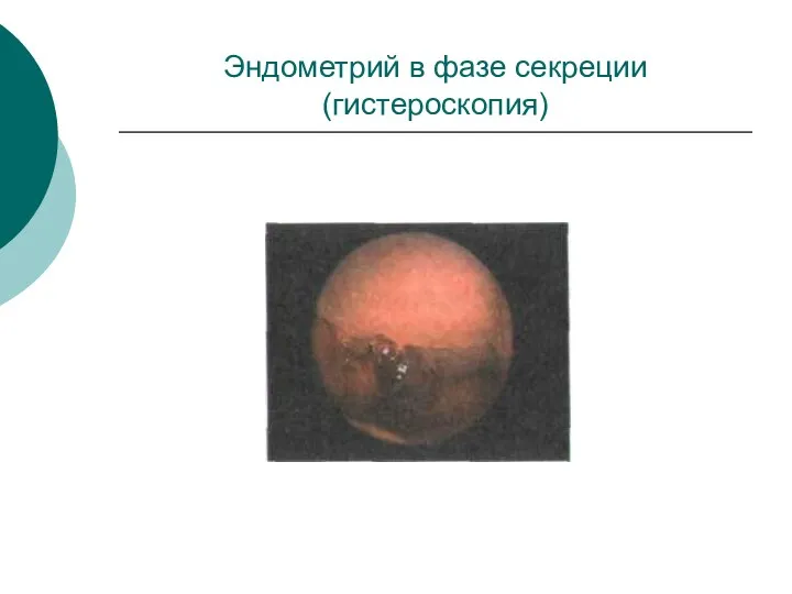 Эндометрий в фазе секреции (гистероскопия)