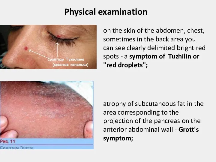 Physical examination on the skin of the abdomen, chest, sometimes