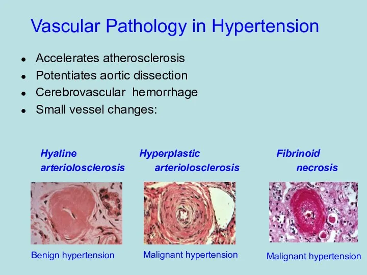 Vascular Pathology in Hypertension Accelerates atherosclerosis Potentiates aortic dissection Cerebrovascular