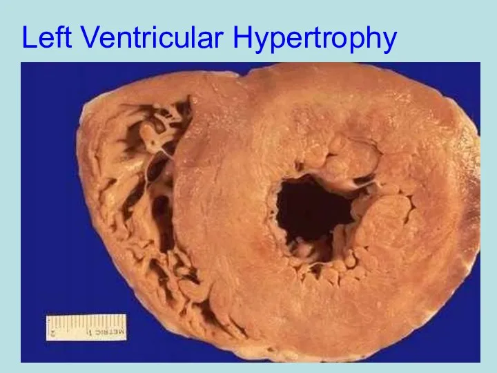 Left Ventricular Hypertrophy