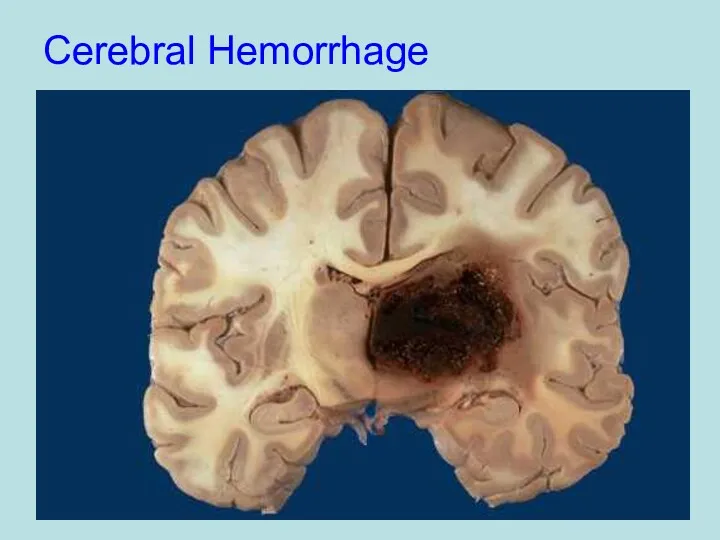 Cerebral Hemorrhage