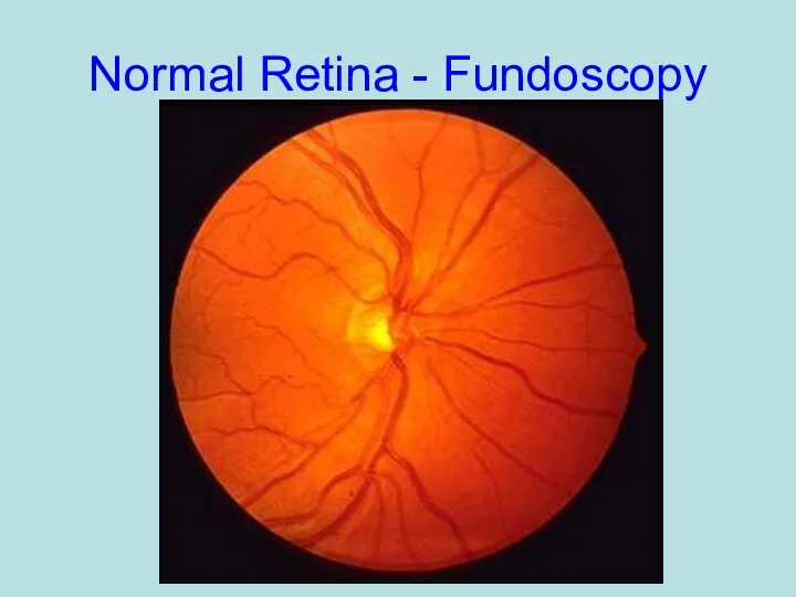 Normal Retina - Fundoscopy