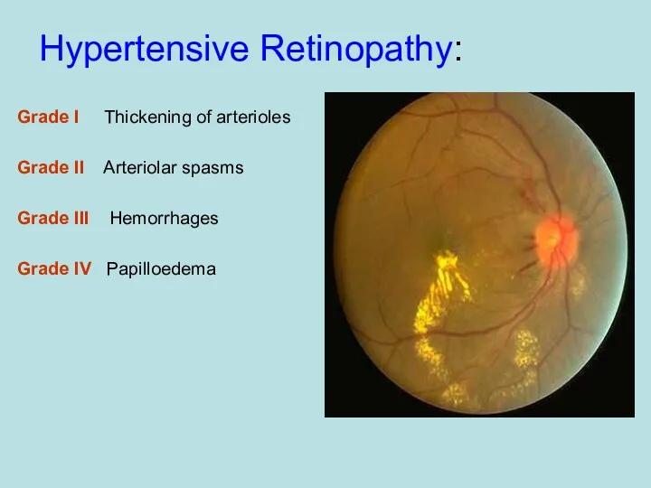 Hypertensive Retinopathy: Grade I Thickening of arterioles Grade II Arteriolar