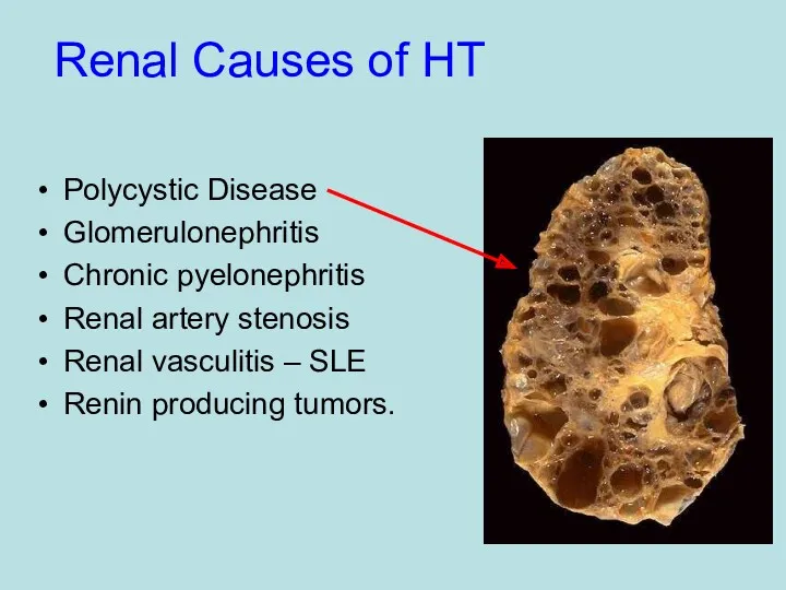 Renal Causes of HT Polycystic Disease Glomerulonephritis Chronic pyelonephritis Renal