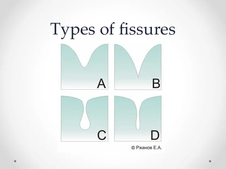 Types of fissures