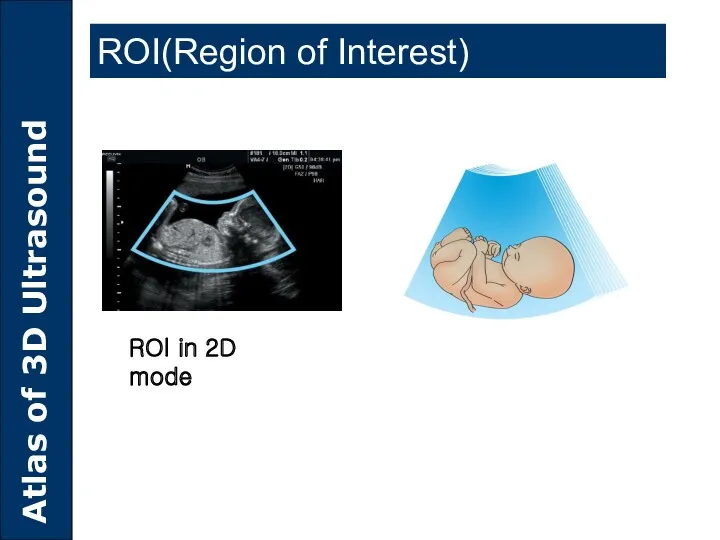 ROI(Region of Interest) ROI in 2D mode