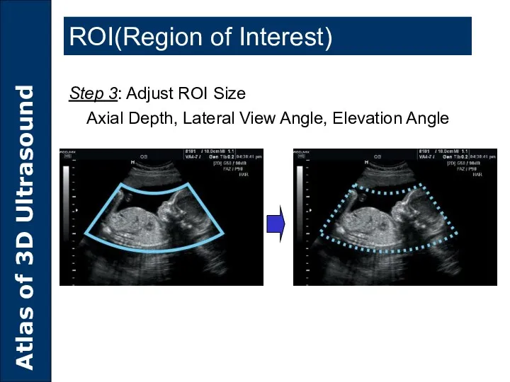 Step 3: Adjust ROI Size Axial Depth, Lateral View Angle, Elevation Angle ROI(Region of Interest)