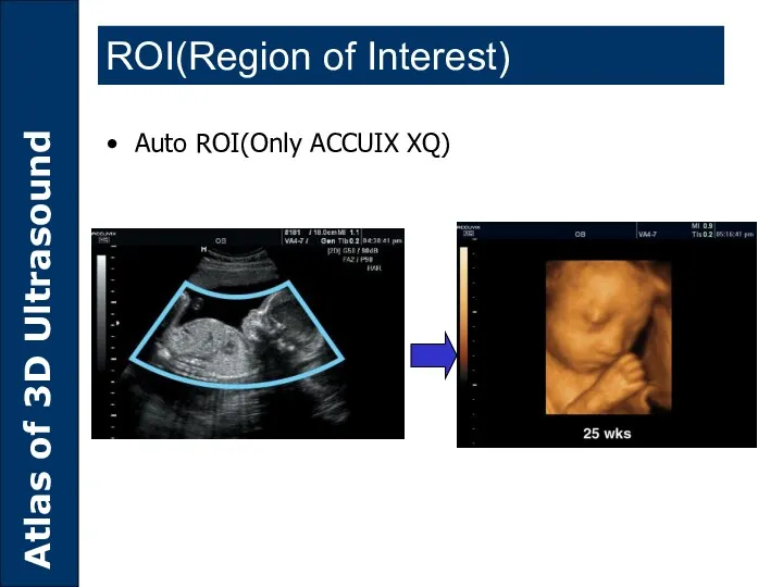Auto ROI(Only ACCUIX XQ) ROI(Region of Interest)