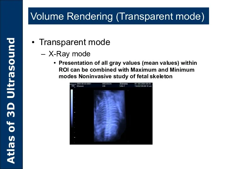Volume Rendering (Transparent mode) Transparent mode X-Ray mode Presentation of