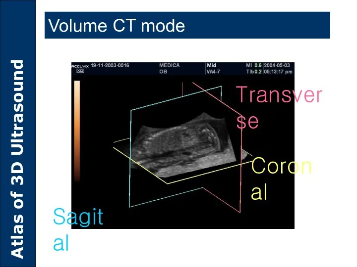 Coronal Transverse Sagital Volume CT mode
