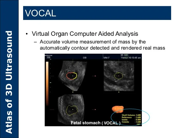 VOCAL Virtual Organ Computer Aided Analysis Accurate volume measurement of