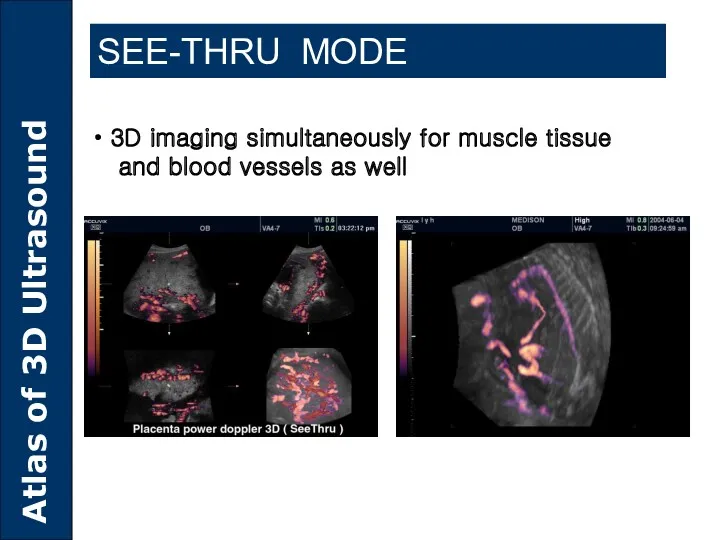 SEE-THRU MODE 3D imaging simultaneously for muscle tissue and blood vessels as well