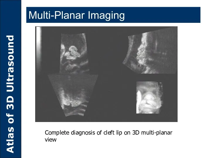Multi-Planar Imaging Complete diagnosis of cleft lip on 3D multi-planar view