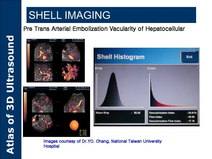 SHELL IMAGING Pre Trans Arterial Embolization Vacularity of Hepatocellular Images
