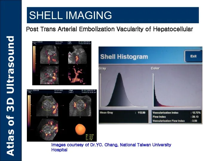 SHELL IMAGING Post Trans Arterial Embolization Vacularity of Hepatocellular Images