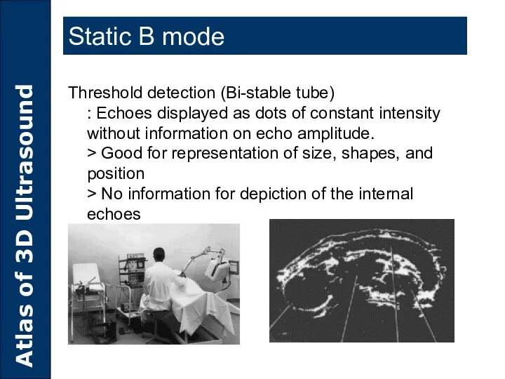 Static B mode Threshold detection (Bi-stable tube) : Echoes displayed