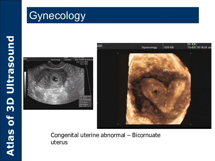 Congenital uterine abnormal – Bicornuate uterus Gynecology