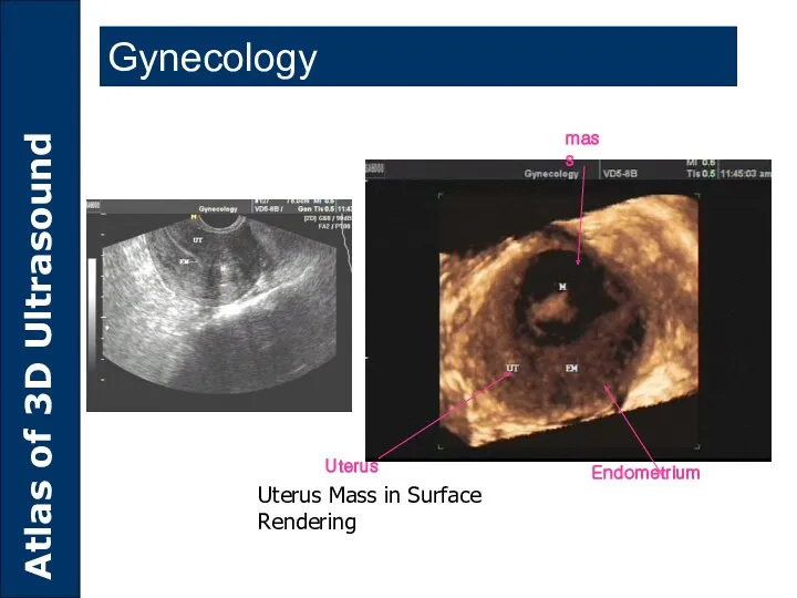 Uterus Mass in Surface Rendering Gynecology Endometrium mass Uterus