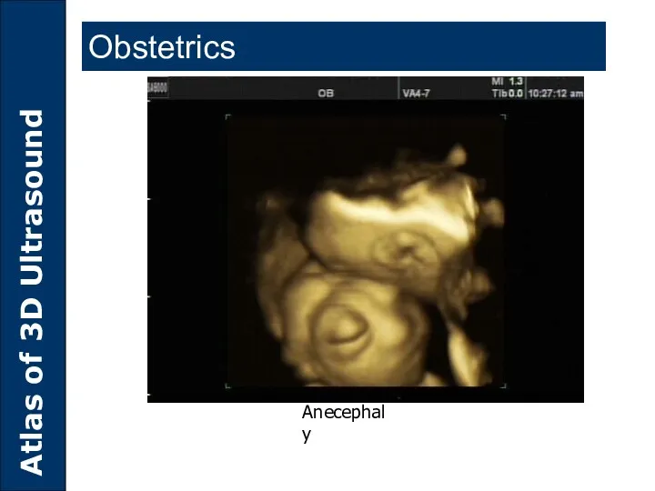 Anecephaly Obstetrics