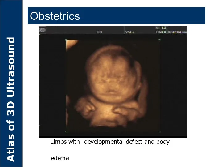 Limbs with developmental defect and body edema Obstetrics